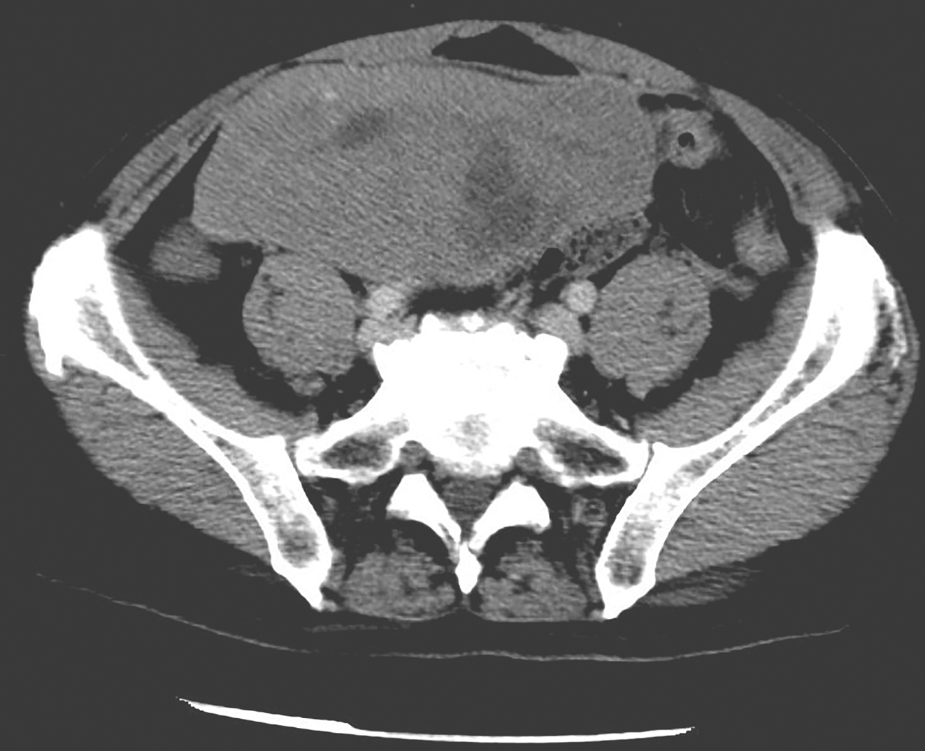 图2 服用伊马替尼1个月后复查腹盆腔增强CT.jpg